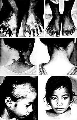 Las fotos muestran los resultados de la radiación en un niño tomado antes y después de la prueba de Bravo.